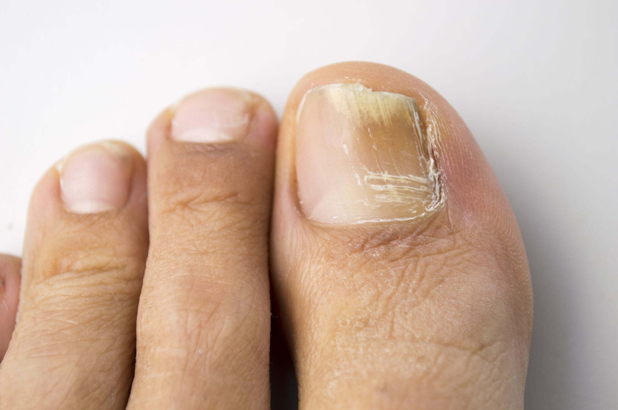 Laser treatment is one of the most effective treatments for a permanent cure of fungal nail infection.