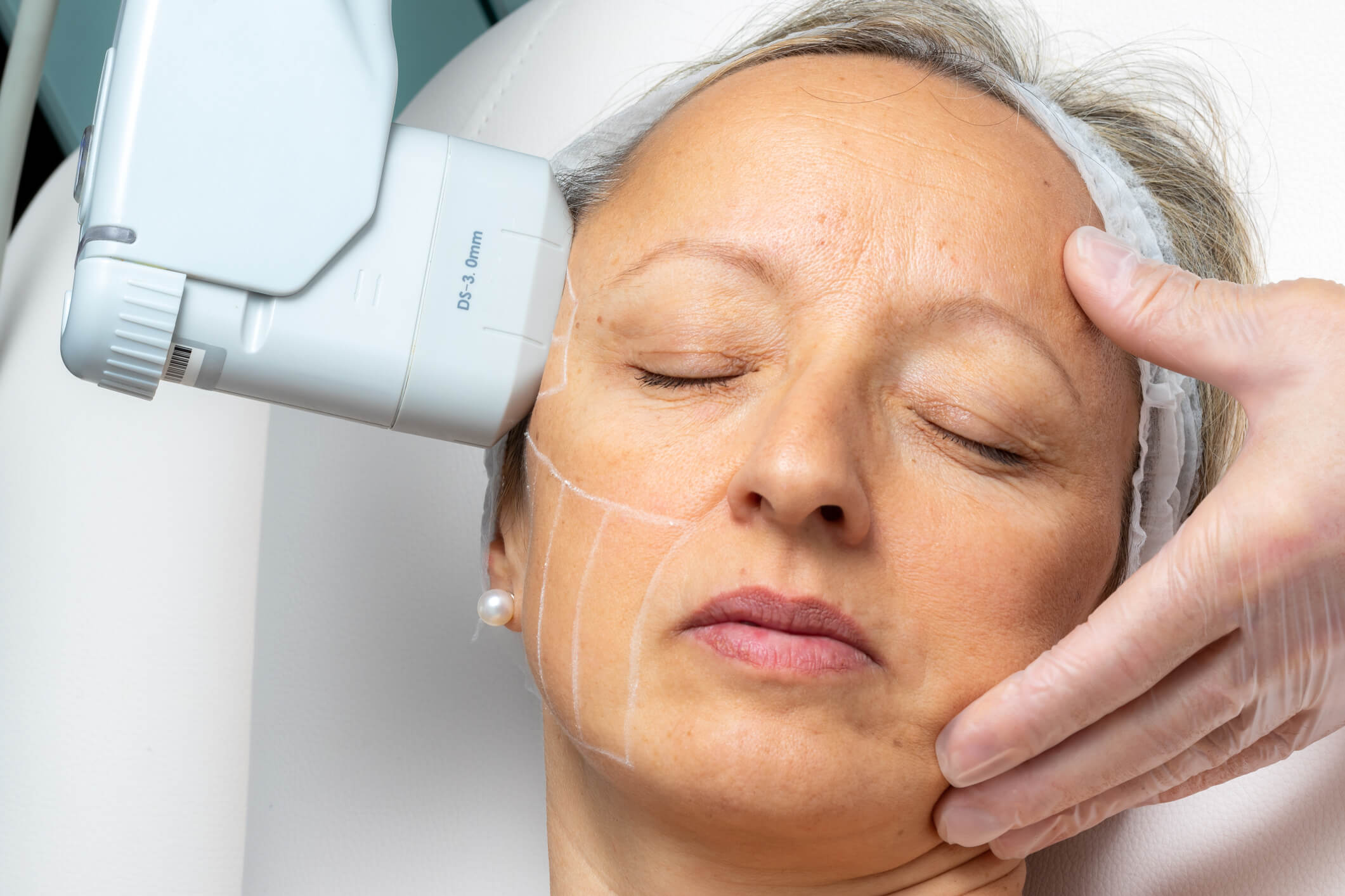 HIFU uses an ultrasound device to tighten and lift skin, to create a fuller and firmer look