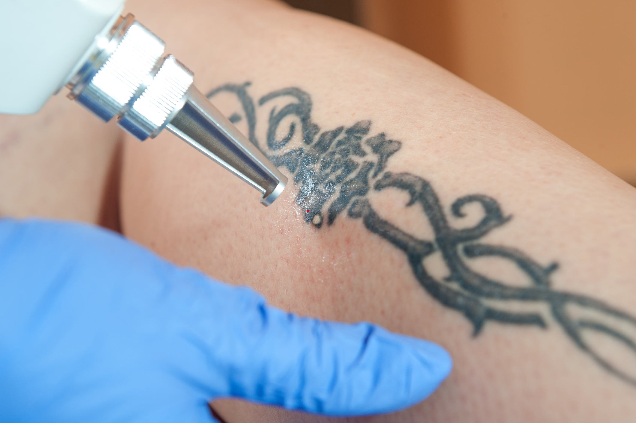 Laser tattoo removal is the safest and most effective treatment for these unwanted tattoos